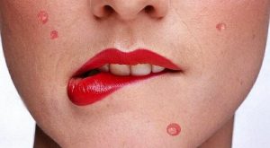 Подкожный клещ: симптомы и лечение